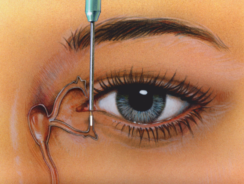 Grafika #0: Zatyczki punktów łzowych w zespole suchego oka